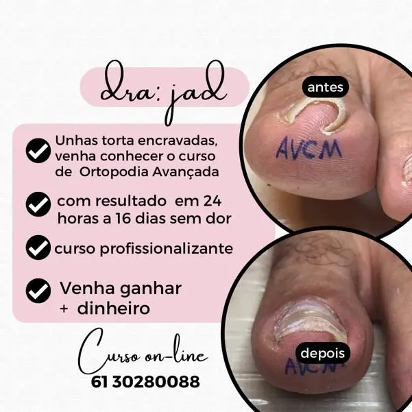 curso para manicure/podologo/ enfermeiros DE ORTOPODIA AVANÇADA