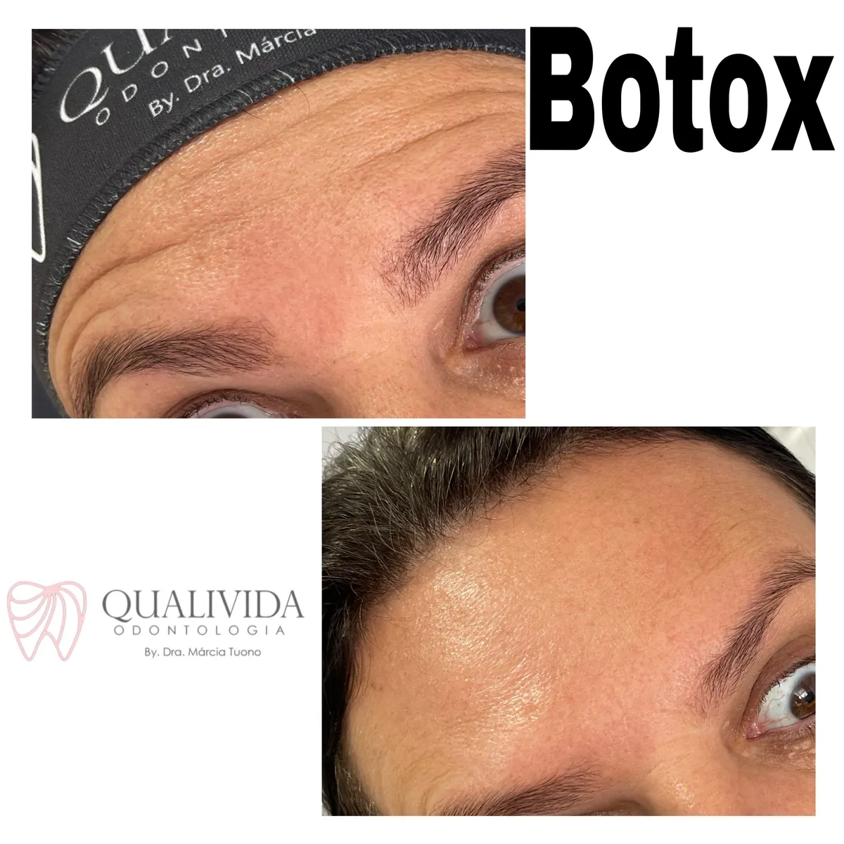 Curso Prático de Toxina Botulínica